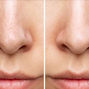 블랙헤드와 화이트헤드 피부 관리 방법